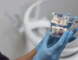 Porselen Kaplamalarla Mükemmel Gülüş Estetiği