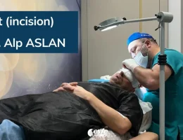 The Search for the Best Hair Transplant Technique 2026